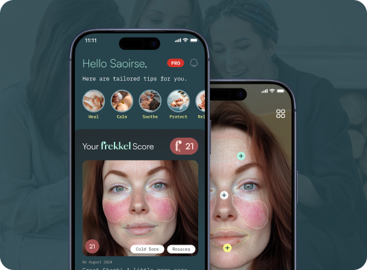 frekkel case study image